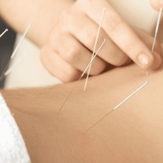 Acupuncture Vs. Dry Needling: What’s The Difference?