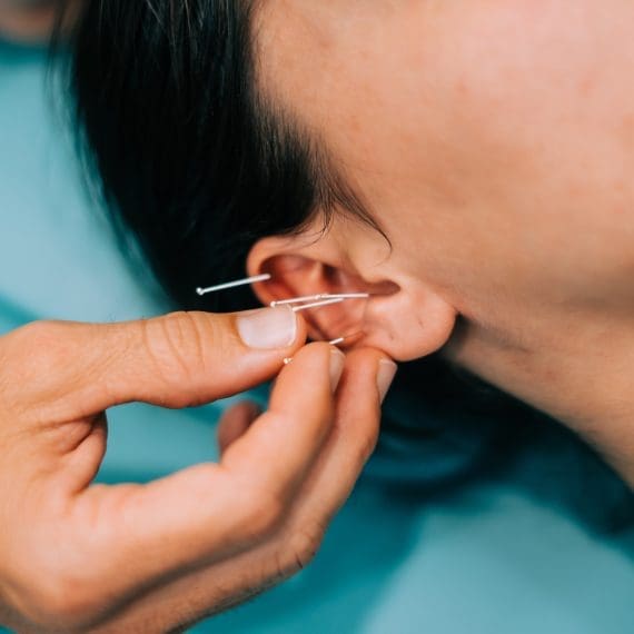 Acupuncture in ear